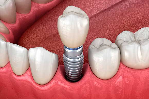 Безоперационная имплантация зубов