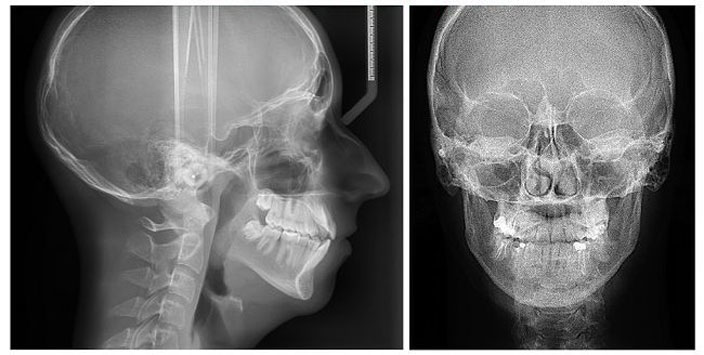 Рентген придаточных пазух носа